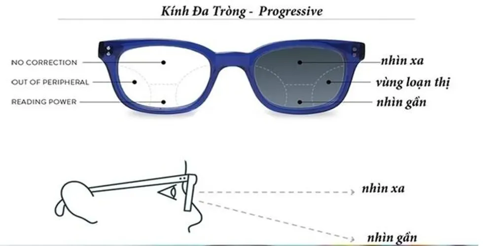 Cận loạn thị là gì và điều trị thế nào để bảo vệ đôi mắt trẻ?