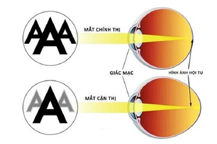 Cận thị là gì và có dấu hiệu, cách chữa trị, phòng tránh thế nào?