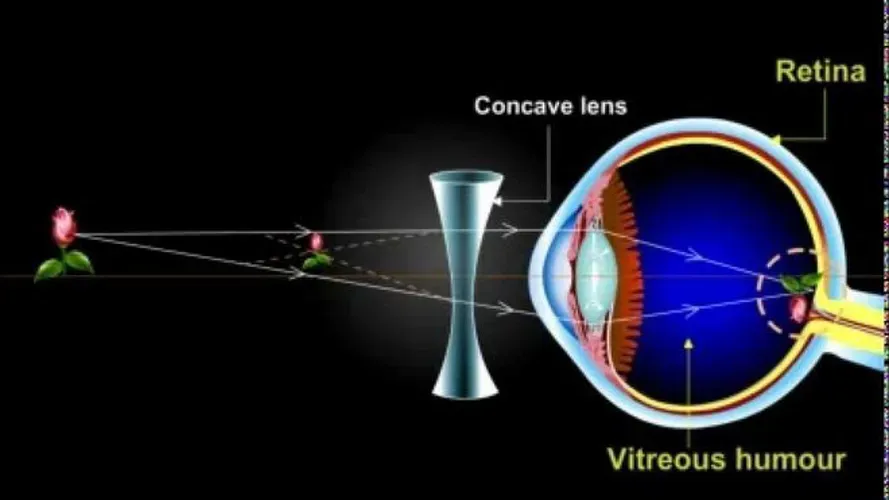 Cận thị là gì và có dấu hiệu, cách chữa trị, phòng tránh thế nào?