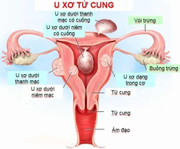 Cảnh báo 5 bệnh hàng đầu về tử cung ở nữ giới gây vô sinh, hiếm muộn