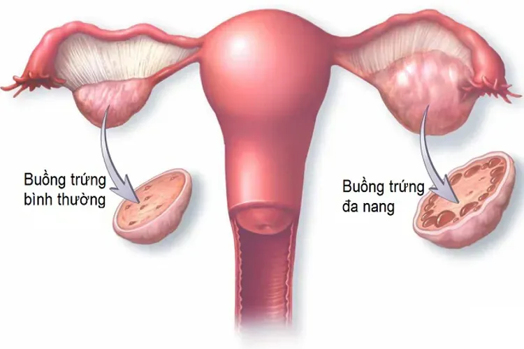 Chậm kinh 10 ngày thì thai được bao nhiêu tuần và những nguyên nhân trễ kinh khác bạn nên biết