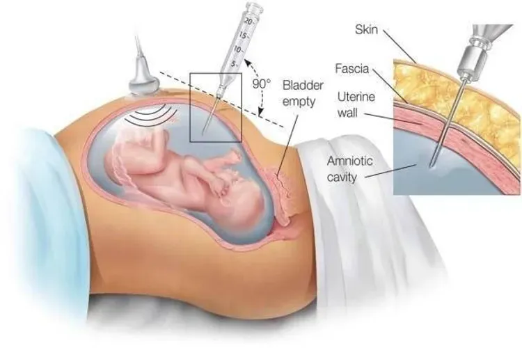 Chọc ối là gì? Những lợi ích và rủi ro khi chọc ối trong thai kỳ