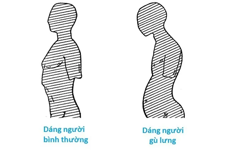 Chống gù lưng vẹo cột sống như thế nào hiệu quả?