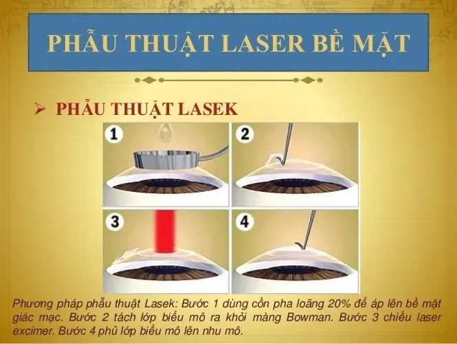 Chữa cận thị bằng laser hết bao nhiêu tiền và chữa ở đâu đáng tin cậy?