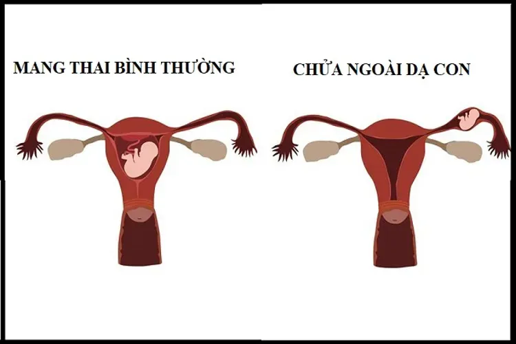 Chửa ngoài dạ con và những điều quan trọng chị em cần biết