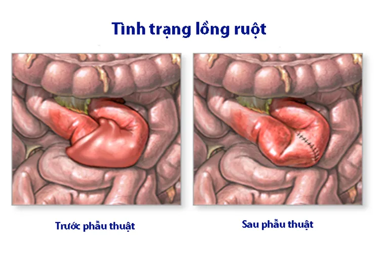 Chứng lồng ruột ở trẻ – một tình trạng bệnh lý nguy hiểm các mẹ cần biết