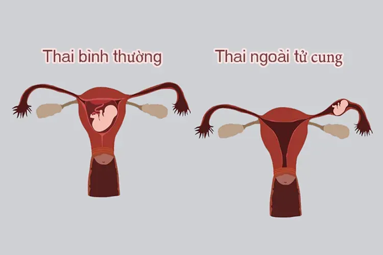 Có thai ngoài tử cung là gì và những dấu hiệu sớm nhất chị em nên biết