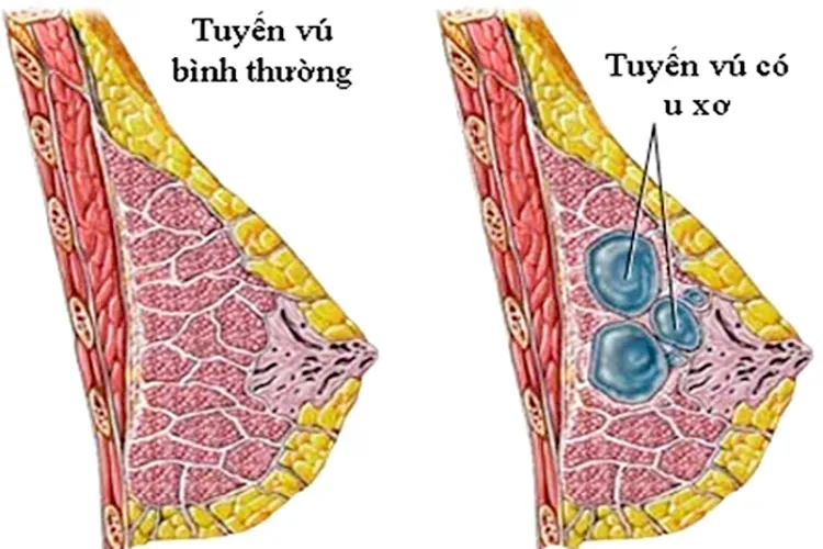 Đau đầu ti sau rụng trứng – dấu hiệu sớm của thai kỳ và các lưu ý khác chị em cần biết