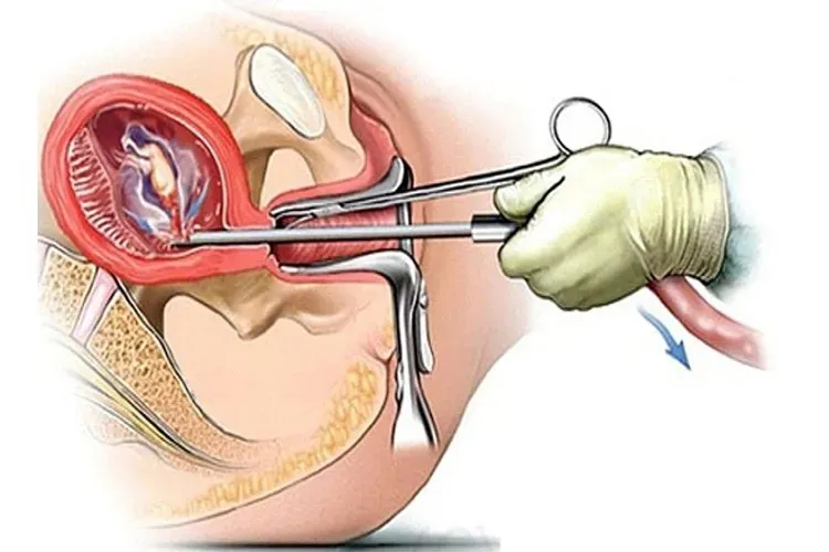 Dấu hiệu có thai ngoài tử cung sớm nhất mẹ bầu cần lưu ý