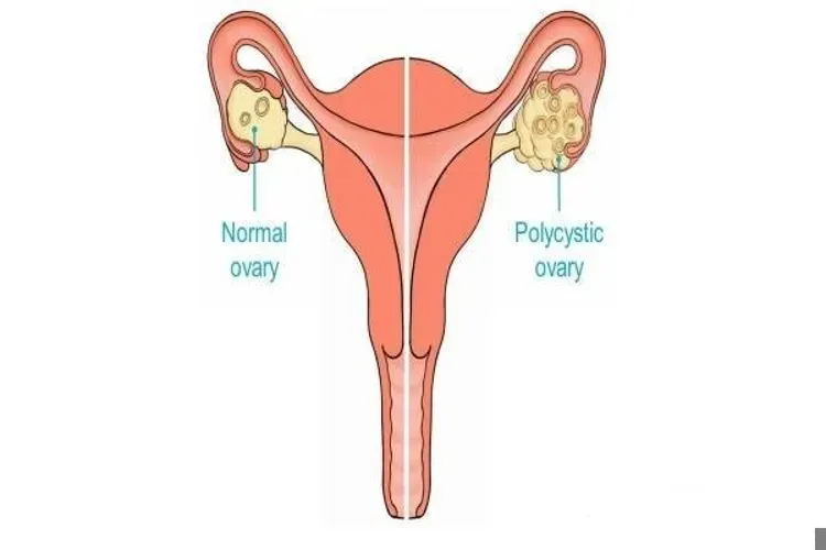 Điều trị 4 dạng buồng trứng đa nang phổ biến bằng thảo dược