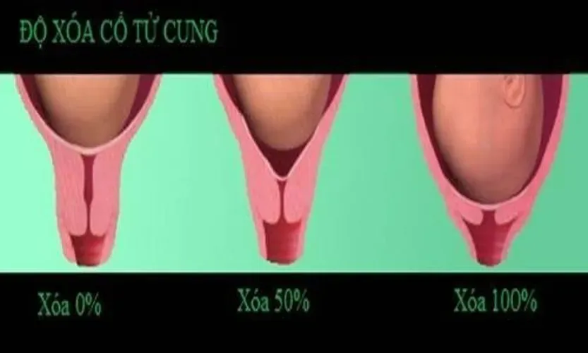 Độ xóa cổ tử cung và vai trò của nó đối với việc chuyển dạ