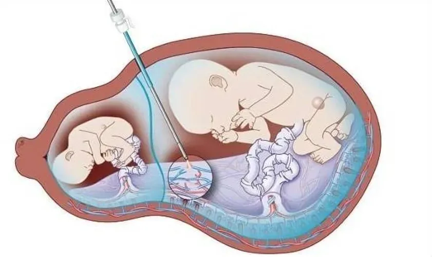 Hiểm họa khi lạm dụng thuốc kích rụng trứng