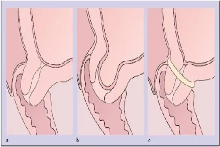 Hở eo tử cung trong thai kỳ và cách xử lý