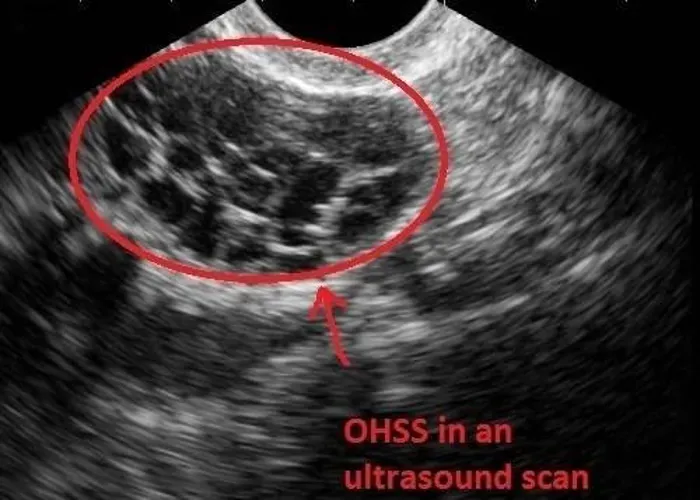 Hội chứng quá kích buồng trứng có thể cản trở quá trình điều trị IVF