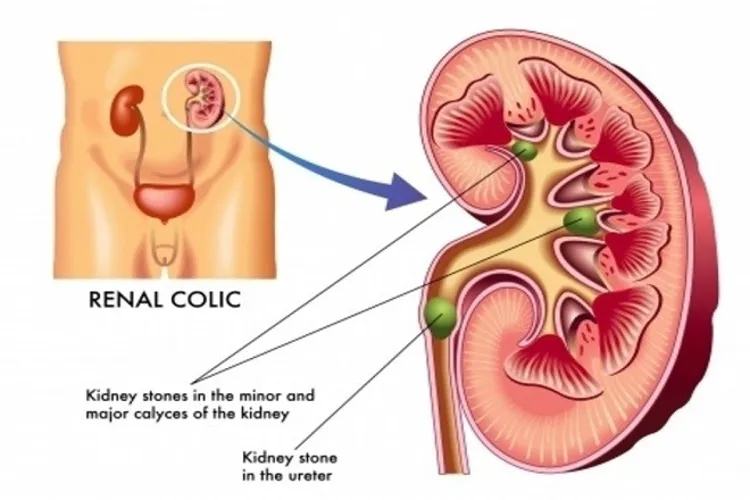 Hút thai 5 tuần tuổi được không và có nguy hiểm không?