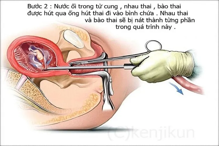 Hút thai 7 tuần tuổi mà những điều chị em cần ghi nhớ