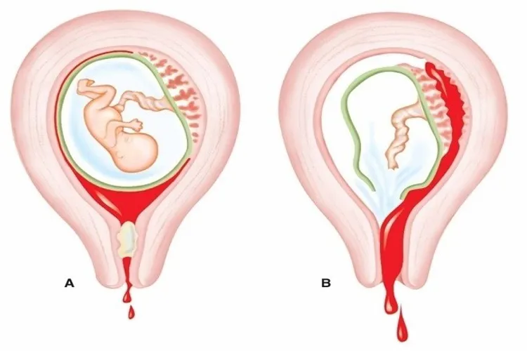 Hút thai bị sót và những điều lưu ý chị em cần nắm kĩ