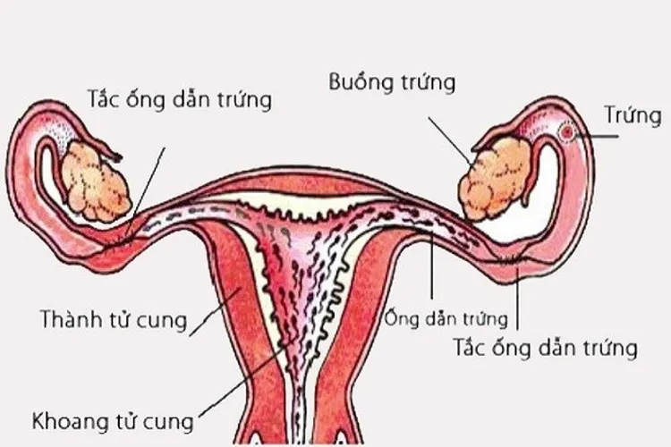 Hút thai có gây vô sinh không?