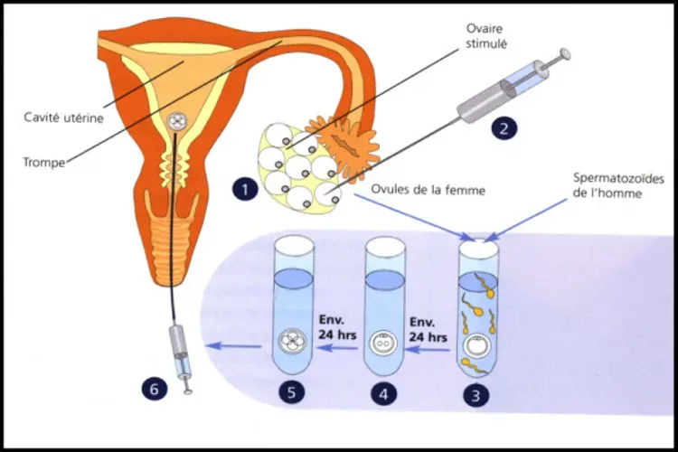 Khi nào nên thụ tinh trong ống nghiệm?