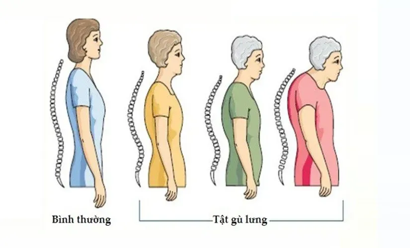 Làm sao để hết gù lưng theo từng cấp độ nguyên nhân gây bệnh?