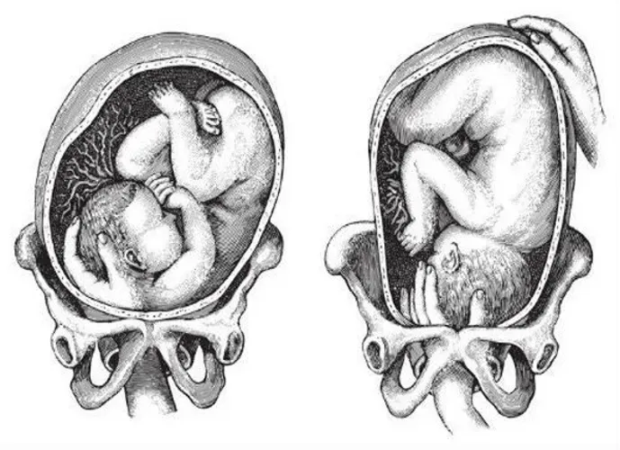 “Làm thế nào để biết con sinh ngôi đầu hay ngôi mông?”, câu trả lời sẽ giúp mẹ cứu được mạng con trong bụng