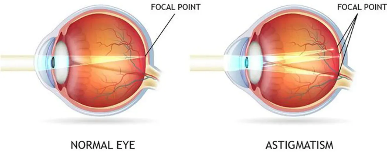 Loạn thị và cận thị cái nào nặng hơn?