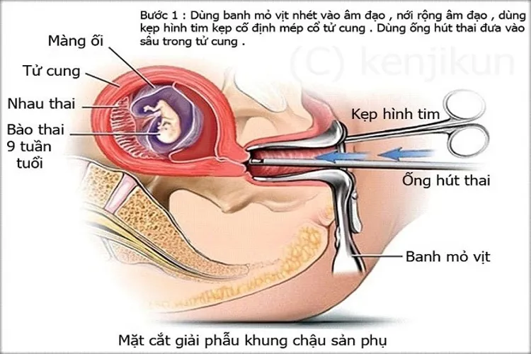 Nạo phá thai là gì và những điều chị em cần biết