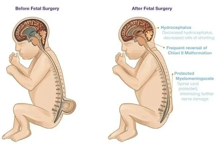 Nguyên nhân và cách phòng ngừa dị tật nứt đốt sống ở thai nhi