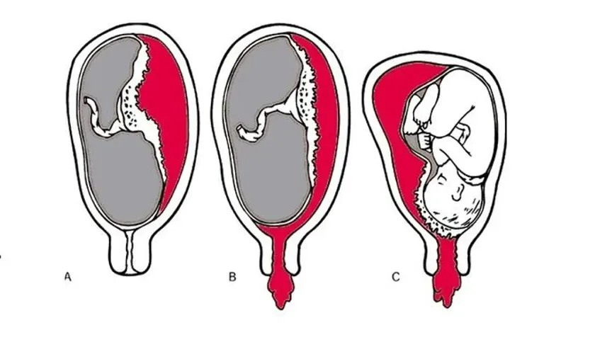 Nhận biết máu báo thai sau khi quan hệ các mẹ cần lưu ý