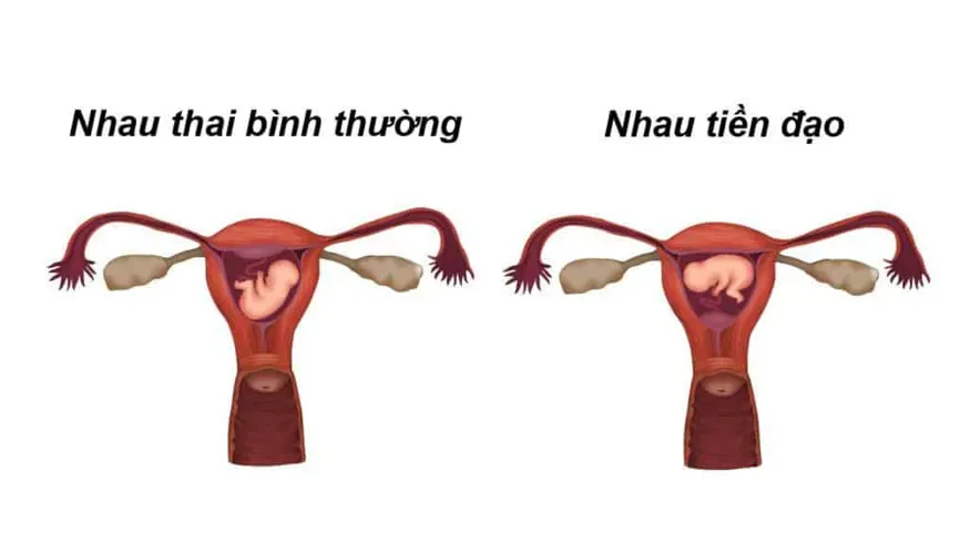 Nhau tiền đạo và những điều mẹ bầu cần biết để đảm bảo sức khỏe thai kỳ