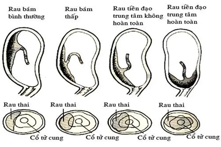 Nhau tiền đạo và những điều mẹ bầu cần biết để đảm bảo sức khỏe thai kỳ