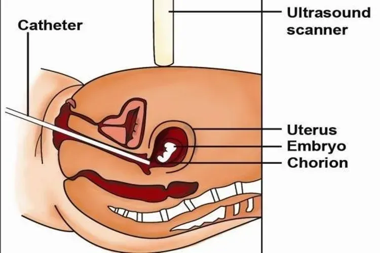 Những điều cần biết về xét nghiệm sinh thiết gai nhau thai