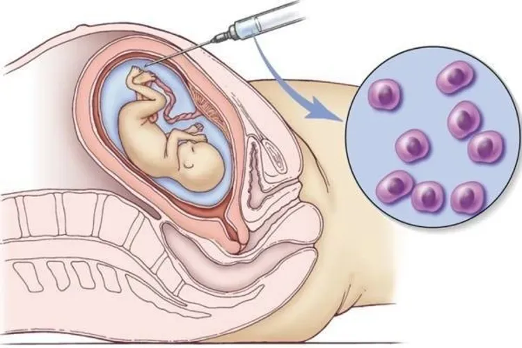 Những điều cần biết về xét nghiệm sinh thiết gai nhau thai