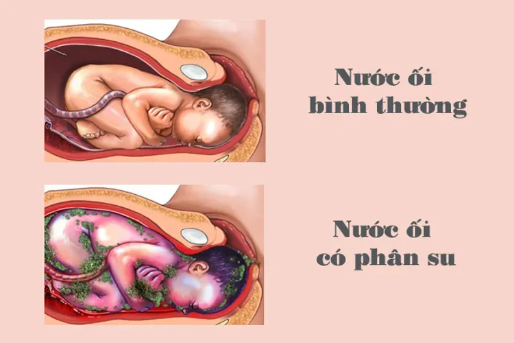 Nước ối đục có ảnh hưởng đến thai nhi hay không?