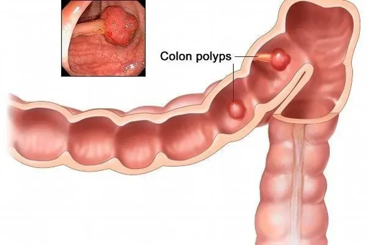 Polyp cổ tử cung ảnh hưởng đến khả năng mang thai?