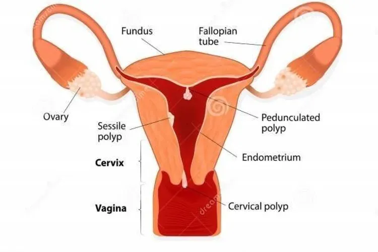 Polyp cổ tử cung ảnh hưởng đến khả năng mang thai?