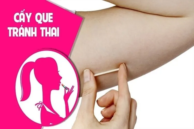 Que cấy tránh thai và những lưu ý cho chị em khi sử dụng