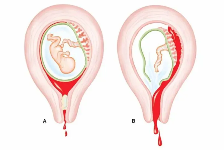 Ra máu khi mang thai tháng đầu có nguy hiểm không?