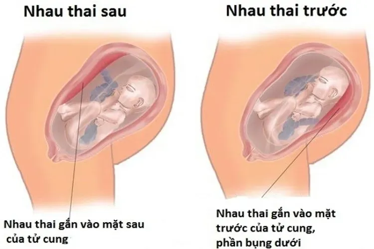 Rau bám mặt trước có phải nhau tiền đạo không?