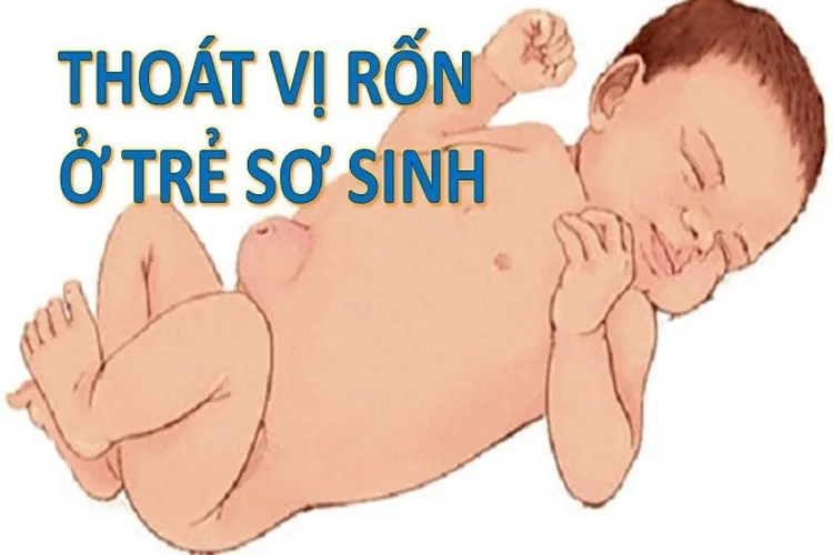 Rốn trẻ sơ sinh và những vấn đề liên quan mẹ cần biết