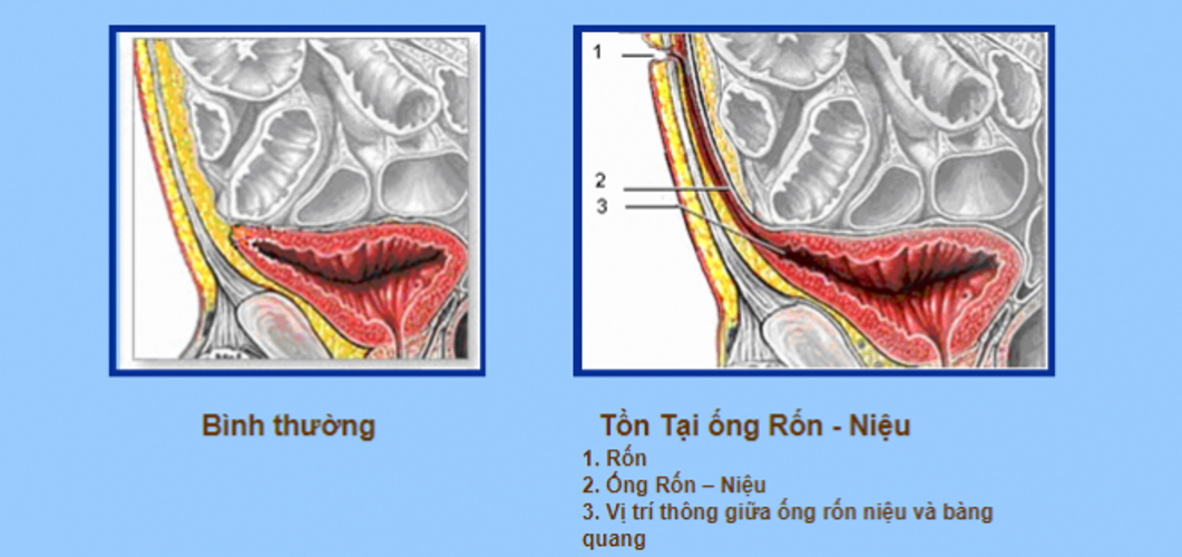 Rốn trẻ sơ sinh và những vấn đề liên quan mẹ cần biết