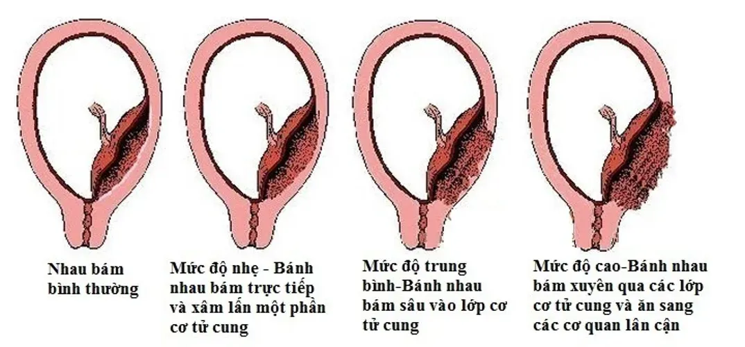 Sinh mổ 1 năm có bầu lại được không và lời khuyên từ các chuyên gia