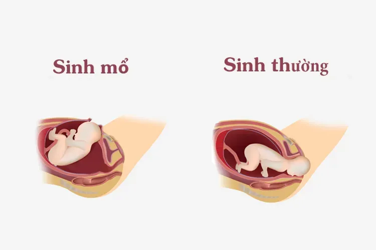 Sinh thường và sinh mổ – những thuận lợi cũng như bất lợi chị em nên biết