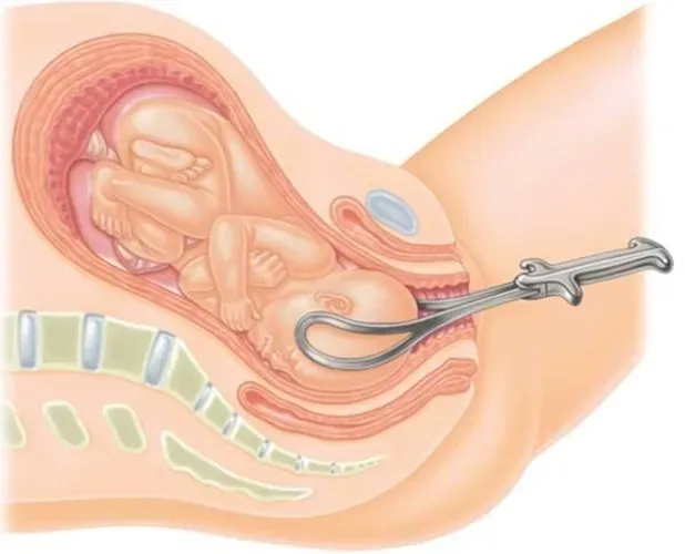 Tác động của dụng cụ trợ sinh đối với mẹ và bé trong sinh thường