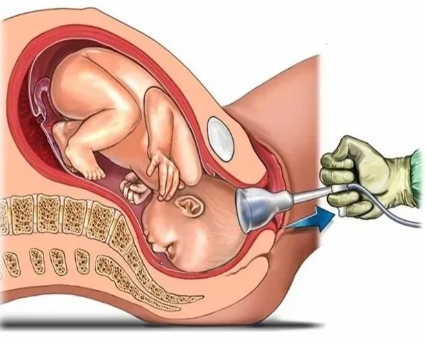 Tác động của dụng cụ trợ sinh đối với mẹ và bé trong sinh thường