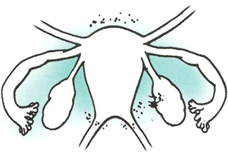 Tại sao khi quan hệ lại ra máu nguyên nhân do đâu?