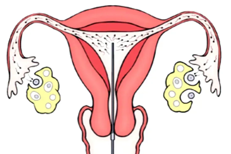 Thụ tinh nhân tạo và 7 điều khái quát giúp bạn dễ dàng nắm bắt nhất