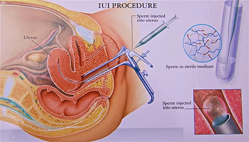 Thụ tinh nhân tạo và những điều cần lưu ý để cặp đôi hiếm muộn tham khảo