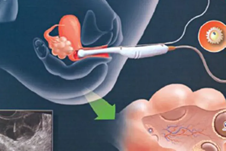 Thụ tinh nhân tạo và những điều cần lưu ý để cặp đôi hiếm muộn tham khảo