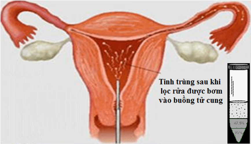 Thụ tinh nhân tạo và những điều cần lưu ý để cặp đôi hiếm muộn tham khảo